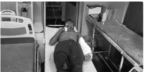 పెయింటింగ్ డ‌బ్బా పేలి తెగి ప‌డిన చేతివేళ్లు