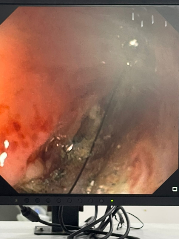 રમતમાં બટન સેલ ગળી ગયેલા પાંચ મહીનાના બાળકને અમદાવાદ સિવિલના ડોક્ટર્સે બચાવ્યો રમતમાં બટન સેલ ગળી ગયેલા પાંચ મહીનાના બાળકને અમદાવાદ સિવિલના ડોક્ટર્સે બચાવ્યો