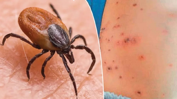 AP Scrub Typhus Alert: Woman Dies With it in Vizianagaram, Know Symptoms, Cause AP Scrub Typhus Alert: Woman Dies With it in Vizianagaram, Know Symptoms, Cause