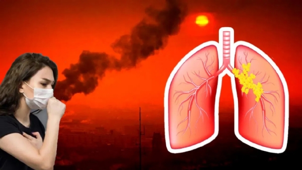 Delhi Air Pollution: Lung Cancer Threat for Non Smokers, Adenocarcino Delhi Air Pollution: Lung Cancer Threat for Non Smokers, Adenocarcino