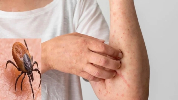 Health Alert: The Growing Threat of Scrub Typhus – Symptoms, Risks, and Ur