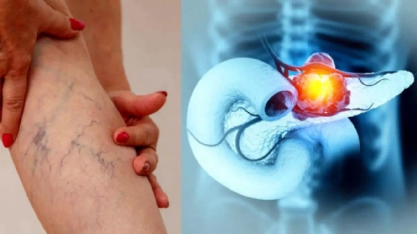 Warning Signs of Cancer in Legs and DVT Symptoms: Det